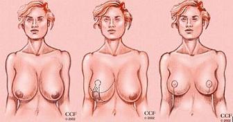 breast augmentation Archives - Ashley F. Miller